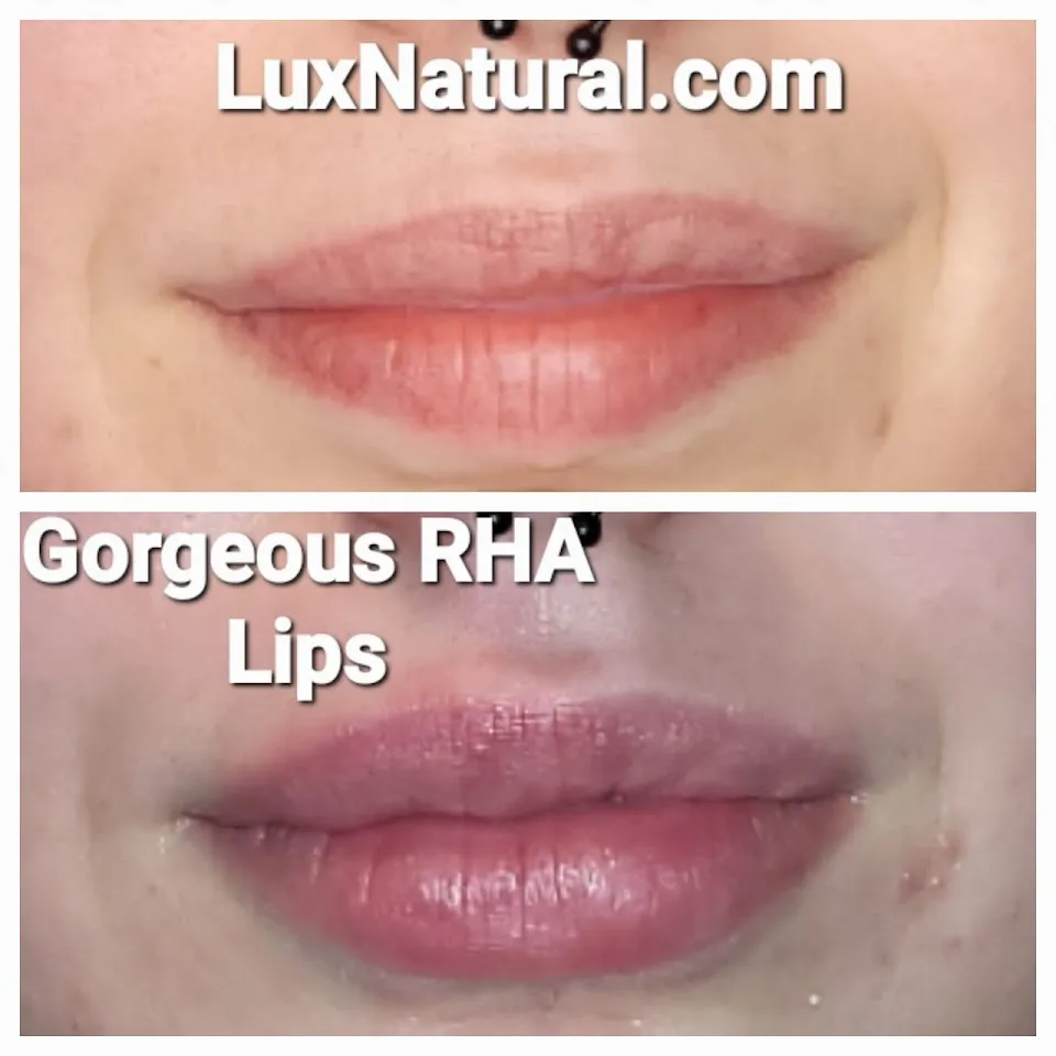 LUX AESTHETIC MEDSPA / CLAYTON, GEORGIA